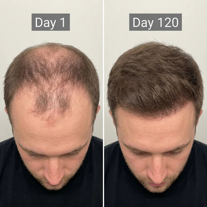 lumavita™ hair growth laser cap