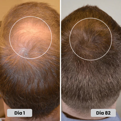 lumavita™ hair growth laser cap